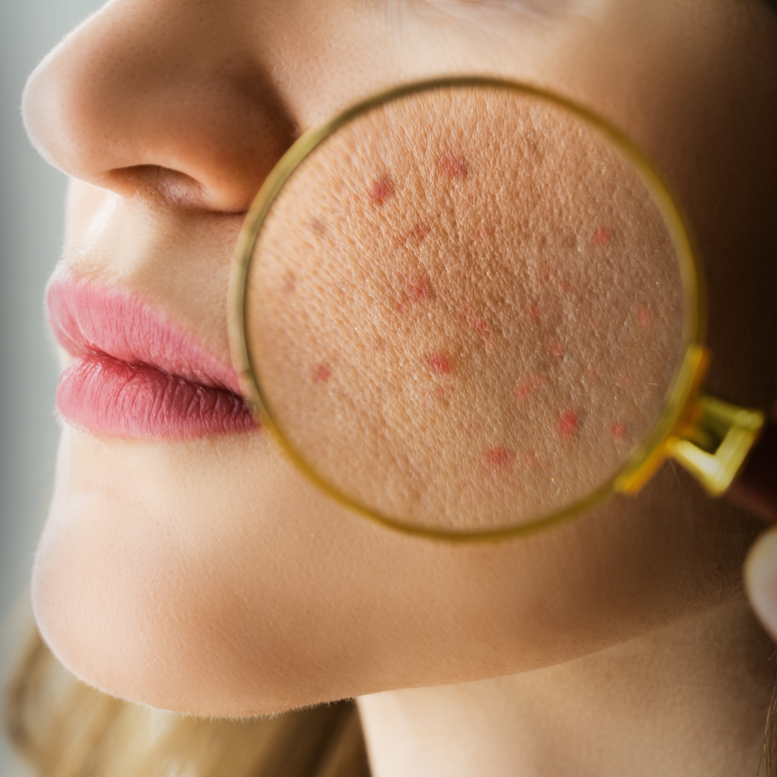 Skin Barrier Health Microbiome Care: The Future of Skincare